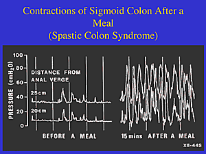 IBS Gut Contractions Graph